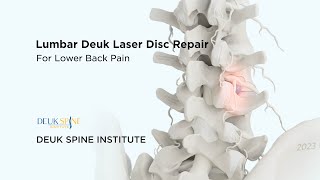 Lumbar Deuk Laser Disc Repair DLDR for Discogenic Back Pain  3D Animation [upl. by Tarrant654]