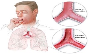 How to Get Rid of Bronchitis Naturally Best Home Remedies [upl. by Okoyk]