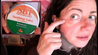 Skin Reaction Disaster How I Recovered My Rosacea Prone Face not sponsored  Rosy JulieBC [upl. by Fons]