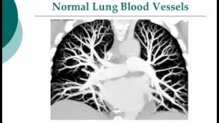 Your Radiologist Explains Computed Tomography CT Pulmonary Embolism [upl. by Constantino700]