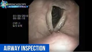 Flexible Bronchoscopy Introduction 6  Airway Inspection Nostril to cords [upl. by Ardnekan]