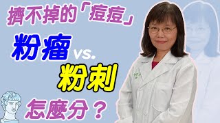 擠不掉的「痘痘」！粉瘤跟粉刺怎麼分？｜好心肝·好健康 [upl. by Apfelstadt]