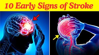 10 Warning Signs of Stroke One Month Before It Happens [upl. by Bakerman]