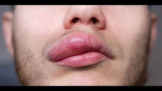 Angioedema  Symptoms and Causes [upl. by Lerat92]