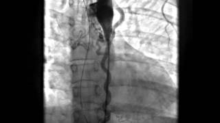 Coarctation of Aorta with Large Collaterals AP view [upl. by Nniw]