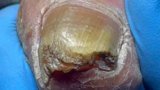 Curly ingrown nails poor onychomycosis【Pedicure Master Lin Jun】 [upl. by Nilerual]