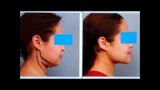 Sculpt the Chin amp Neck With Liposuction  Dr Sterry Explains [upl. by Sonnie102]