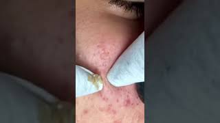 Blackheads Treatments Blackhead Removal Blackhead Treatment Blackhead Extraction Blackheads shorts [upl. by Mintz]