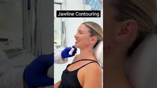 Jawline contouring using fillers [upl. by Aisek]