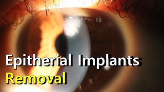 Manual Removal of Epithelial Implants [upl. by Abagail]