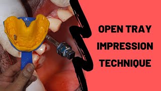 How To Take an Open Tray Implant Impression DEMO [upl. by Kareem]