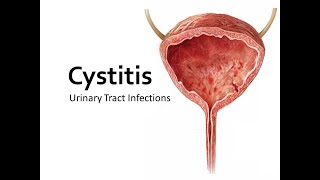 Cystitis lecture [upl. by Nivalc]