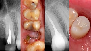 From Endo to Resto full protocol [upl. by Eelyahs]