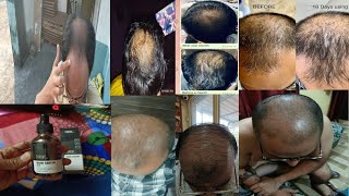 dont use Thriveco Hair growth serum  results before amp after  honest review in hindi [upl. by Ahsienak]