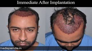 Natural Hair Transplant in India Jaipur Delhi by Dr Suneet Soni at Medispa [upl. by Nert]