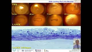 Photorefractive Keratectomy PRK LASEK EpiLASIK ASA TransPRK  Surgeon Training Video [upl. by Tilly]