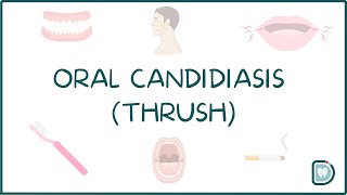 Understanding Oral Candidiasis or Oral Thrush [upl. by Leonora]