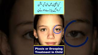 Ptosis or Drooping Eyelid Treatment In Child [upl. by Iramohs]