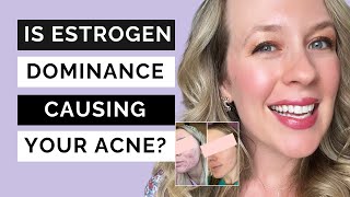 Estrogen dominance acne  IS ESTROGEN CAUSING YOUR ACNE [upl. by Collbaith]