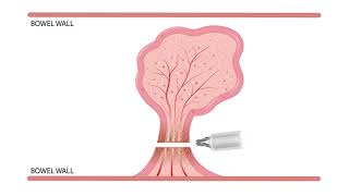 Endoscopy Tech Course  Electrosurgery 5 Hot snare [upl. by Kimbra671]