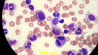 Pure Red Cell Aplasia 4 patients [upl. by Eiramassenav]