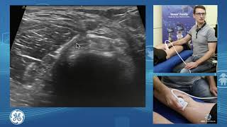 Sonographic assessment of the posterior knee for POCUS clinicians [upl. by Molahs]