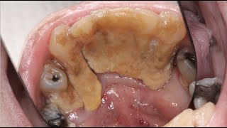 MASSIVE Calculus Buildup  Severe Gum Disease Case [upl. by Annavoj73]