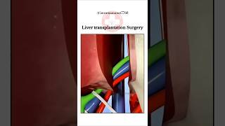 Liver Transplant Surgery LTS shorts medico [upl. by Delsman]