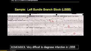 1215 Lead ECG Left Bundle Branch Block [upl. by Erdnad]