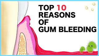 Gum Bleeding Top 10 causes [upl. by Imugem]