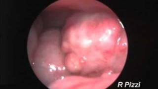 Endoscopy of a chicken with salpingitismp4 [upl. by Lavern259]