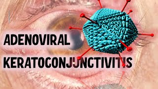 VIRAL CONJUNCTIVITIS  Ultimate Guide to Recognising Clinical Presentations [upl. by Talanta458]