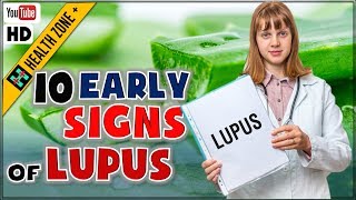 10 Early Signs and Symptoms of Lupus You Shouldn’t Ignore [upl. by Hesketh]