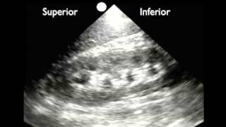 How To Renal Ultrasound  Hydronephrosis Case Study Video [upl. by Siddra986]