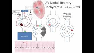 ECG understanding supraventricular tachycardia or SVT [upl. by Vinson]