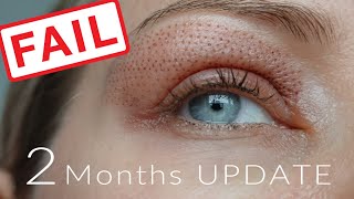 UPDATE 2 Months after fibroblast  FAIL [upl. by Nosretep121]