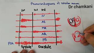 CVS 233  Phonocardiograms of valvular murmurs  Aortic and mitral [upl. by Eselehs]