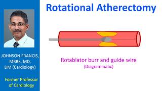 Rotational Atherectomy [upl. by Ailhat]