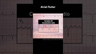 Atrial Flutter ECG Variable AV conduction ratio [upl. by Rebmit]