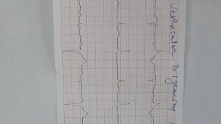 ventricular bigeminy and trigeminy [upl. by Fondea]