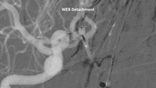 Ruptured small AcomA aneurysm treated with WEB SLS4 [upl. by Avilla]