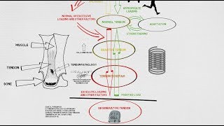 Tendinopathy Continuum and Update [upl. by Medea]