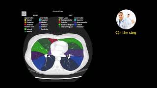 Bronchopulmonary segments annotated CT [upl. by Leksehcey433]