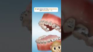 premolar extraction for orthodontic treatment ортодонтия kieferorthopädie ortodonzia orthodontie [upl. by Enovaj]