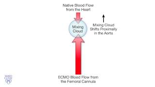 Femoral Cannulation and VenoArterial ECMO  Mayo Clinic [upl. by Ocko]