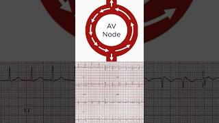 AVNRT ECG [upl. by Skricki]