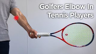 Golfers Elbow In Tennis Players  How To Treat amp Rehab Medial Epicondylitis [upl. by Hollerman909]