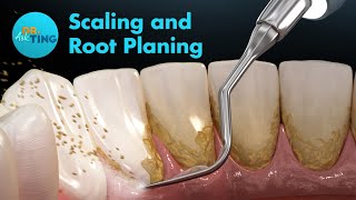 Scaling and Root Planing SRP  Ask Dr Ting [upl. by Anatol]