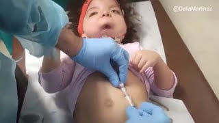 CAMBIO DE BOTON GASTRICO Con Cirujano Gástrico  GASTROSTOMIA [upl. by Notniuqal108]