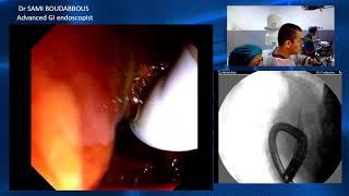 ercp for sems obstruction [upl. by Howarth]